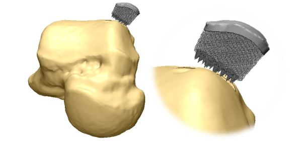 implante osteocondral a medida