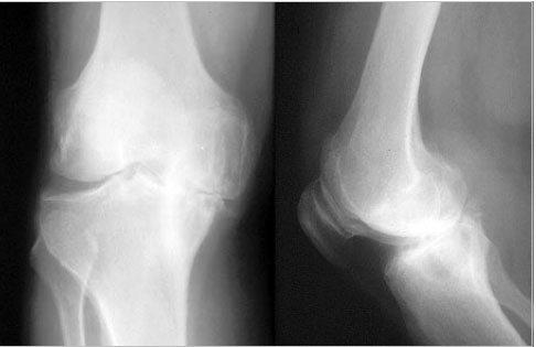 Artrosis de rodilla ¿cómo tratarla? – Centro Privado Segura