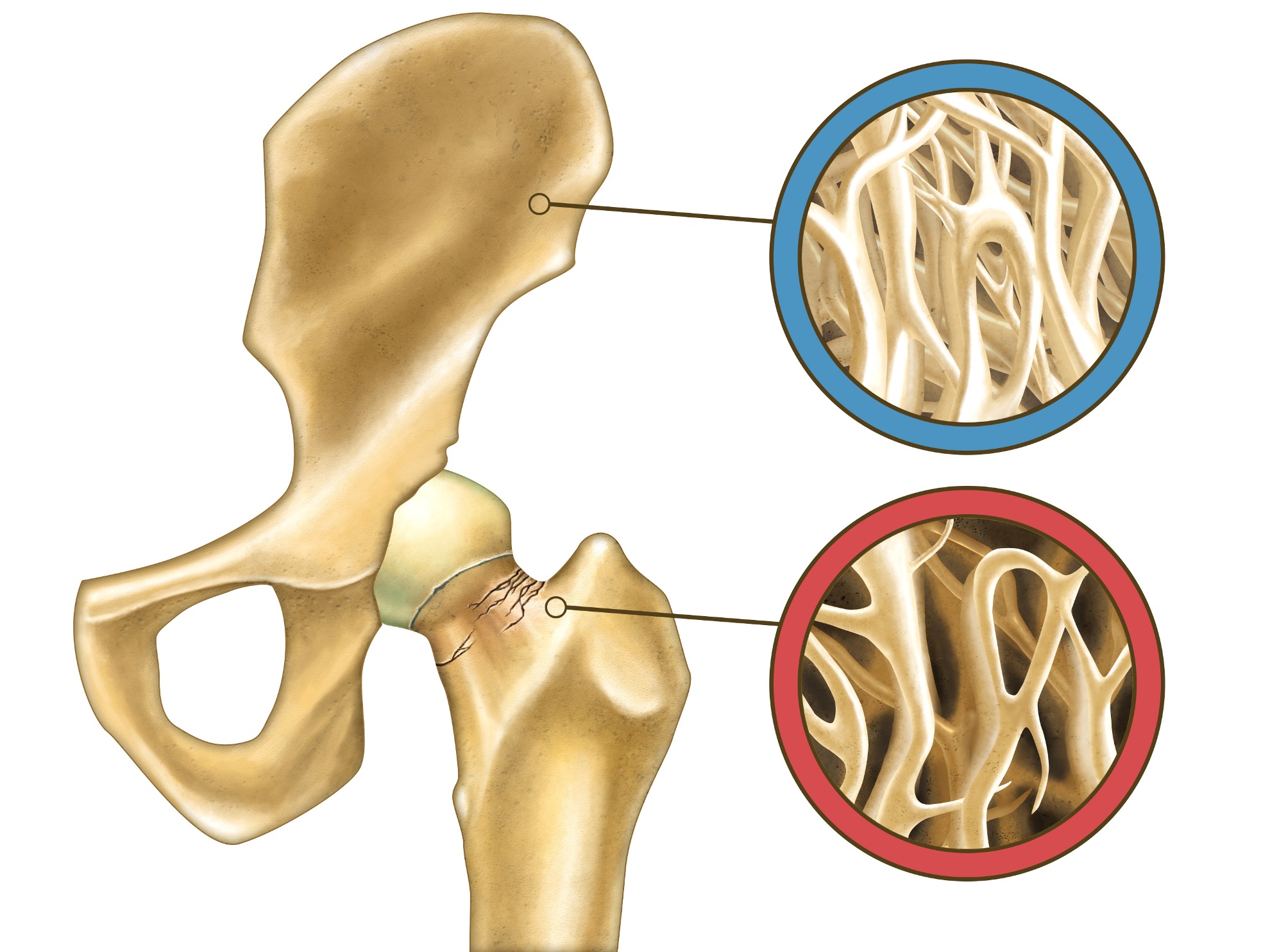 La Osteoporosis Y Su Relación Con Las Fracturas De Cadera Centro Privado Segura 7992