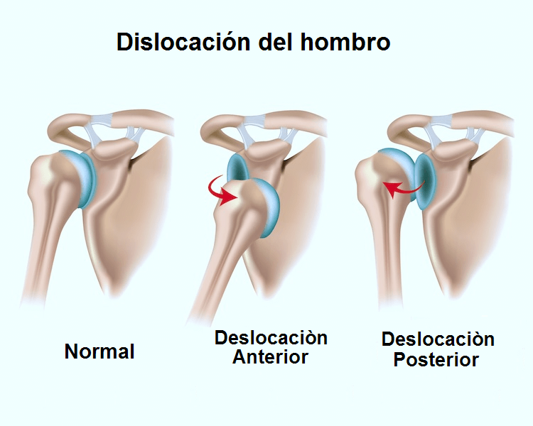 inestabilidad-hombro-ilustracion