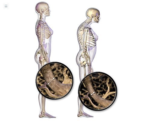 El impacto de la osteoporosis en el cuerpo