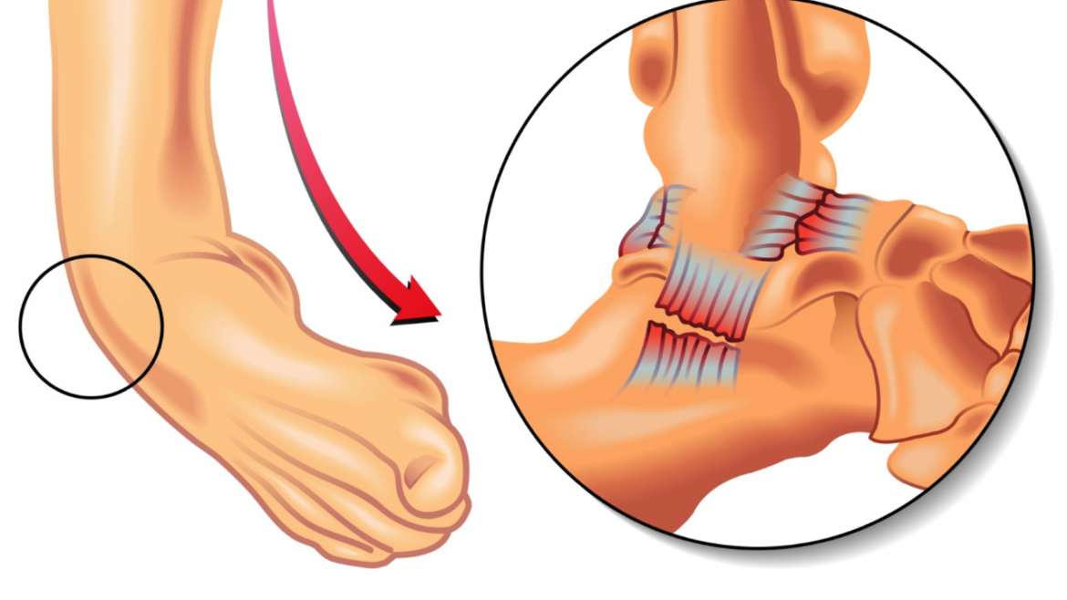 7 tips para prevenir los esguinces de tobillo