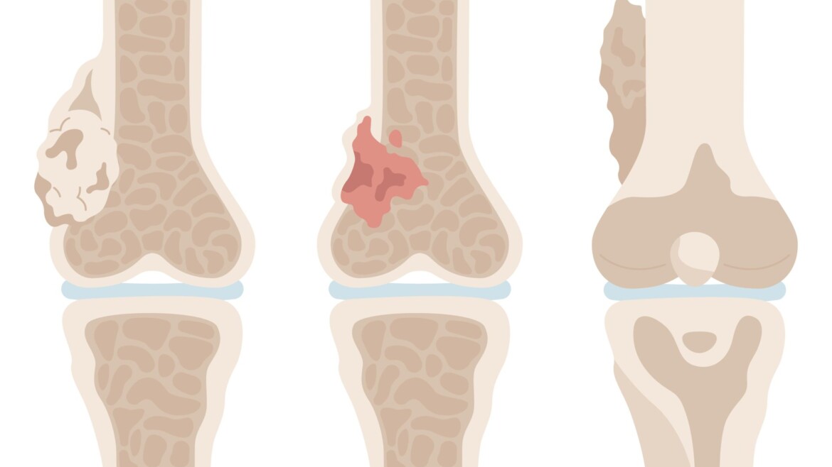 Sarcoma: el tumor poco frecuente que también necesita atención