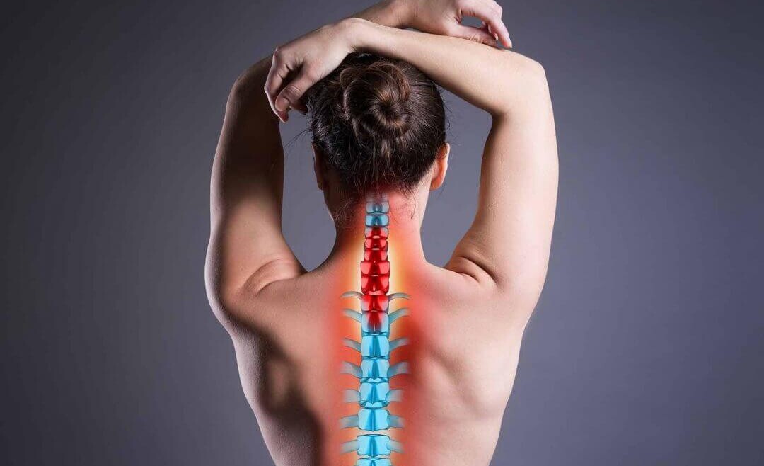 Hernia de disco cervical: cómo prevenirla y tratarla