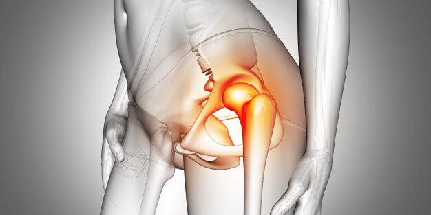 Bursitis de cadera: causas, síntomas y tratamiento